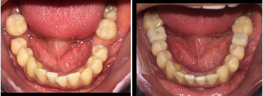 Antes e depois de tratamento com implantes dentários na Oral Unic Campo Grande