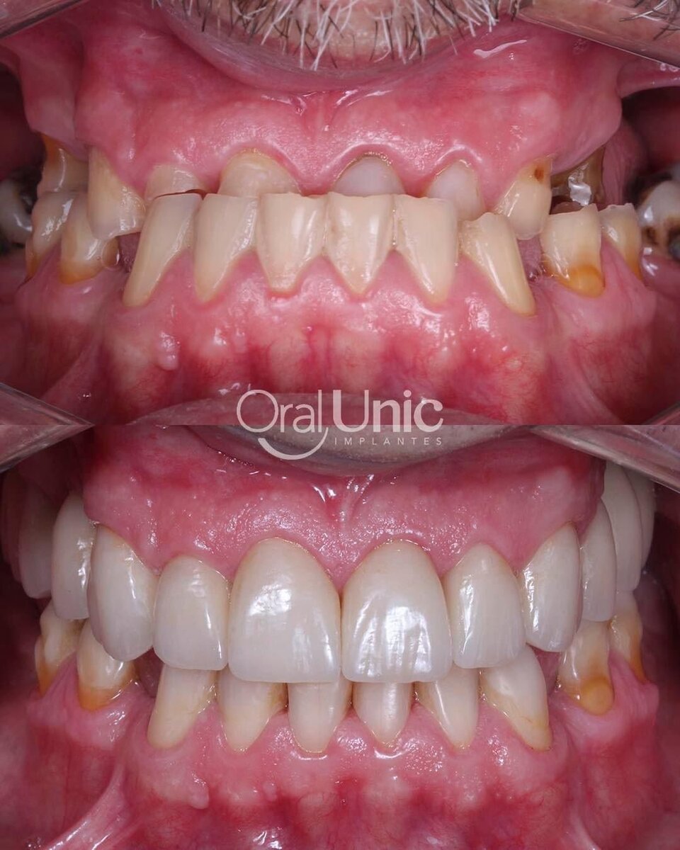 Antes e depois de implantes e coroas dentárias na Oral Unic Campo Grande