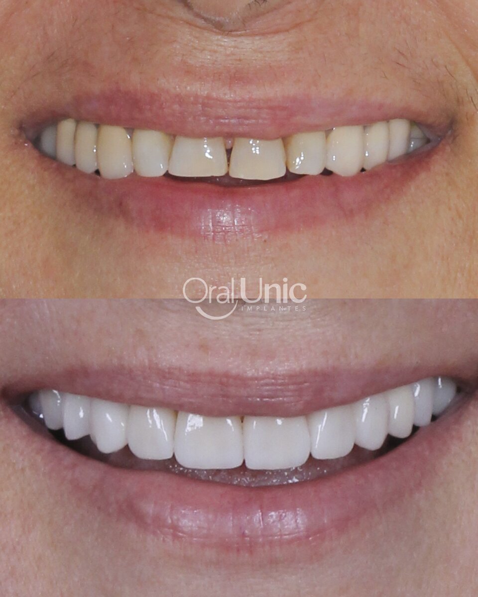 Antes e depois de lentes de contato dental na Oral Unic Campo Grande
