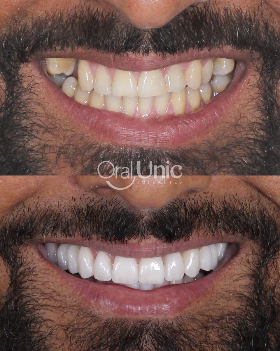 Antes e depois de lentes de contato dental — harmonização do sorriso