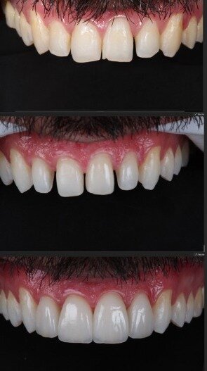 Antes e depois de lentes de contato dental — caso clínico Oral Unic Campo Grande