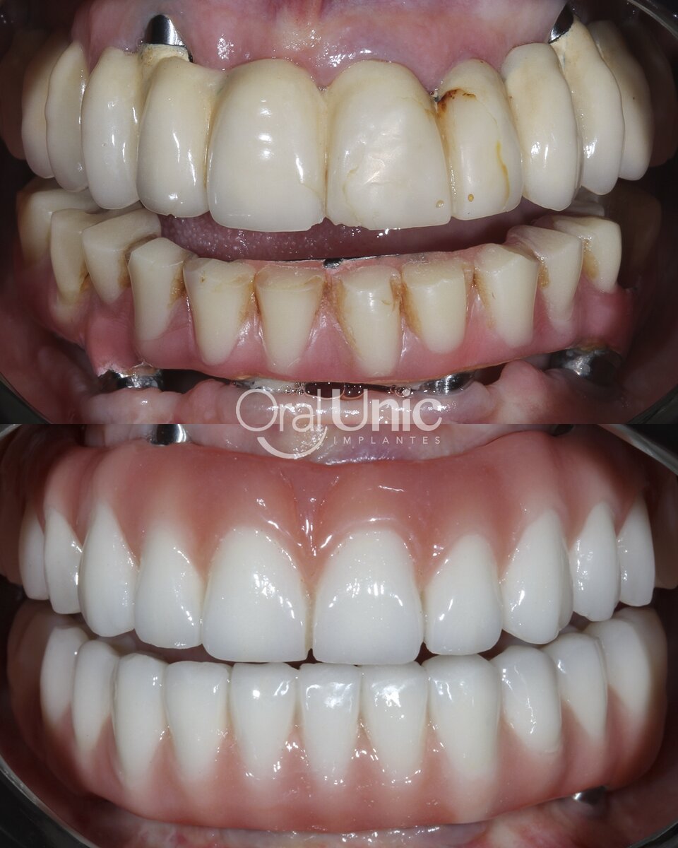 Antes e depois de protocolo de implante fixo na Oral Unic Campo Grande
