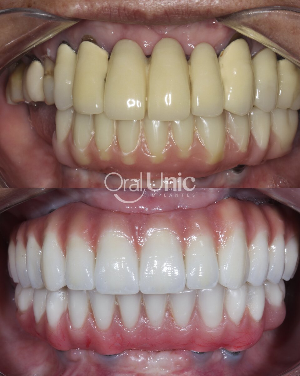 Antes e depois de reabilitação com protocolo na Oral Unic Campo Grande