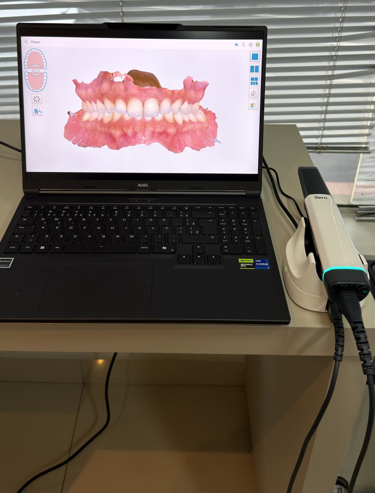 Scanner intraoral iTero para escaneamento dental 3D