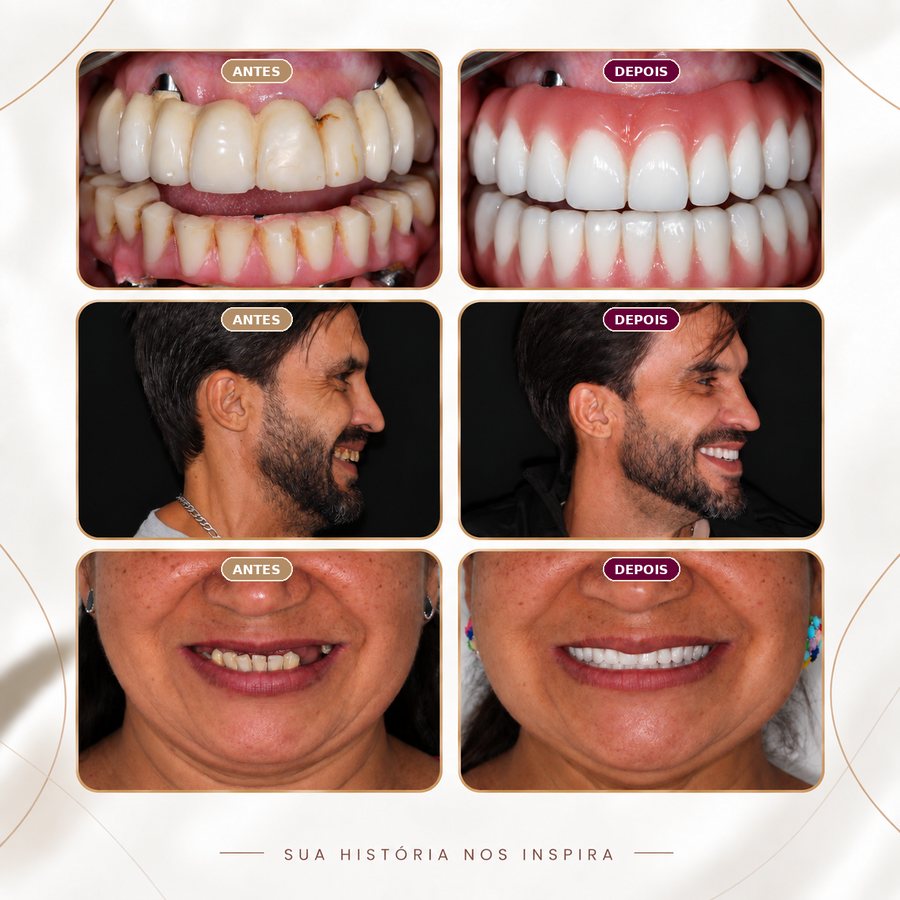 Antes e depois de pacientes da Oral Unic Campo Grande com prótese sobre implante