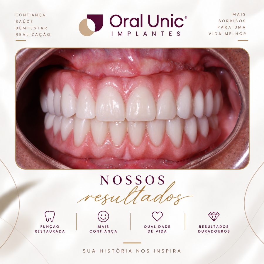 Resultado de reabilitação oral com prótese sobre implante na Oral Unic Campo Grande