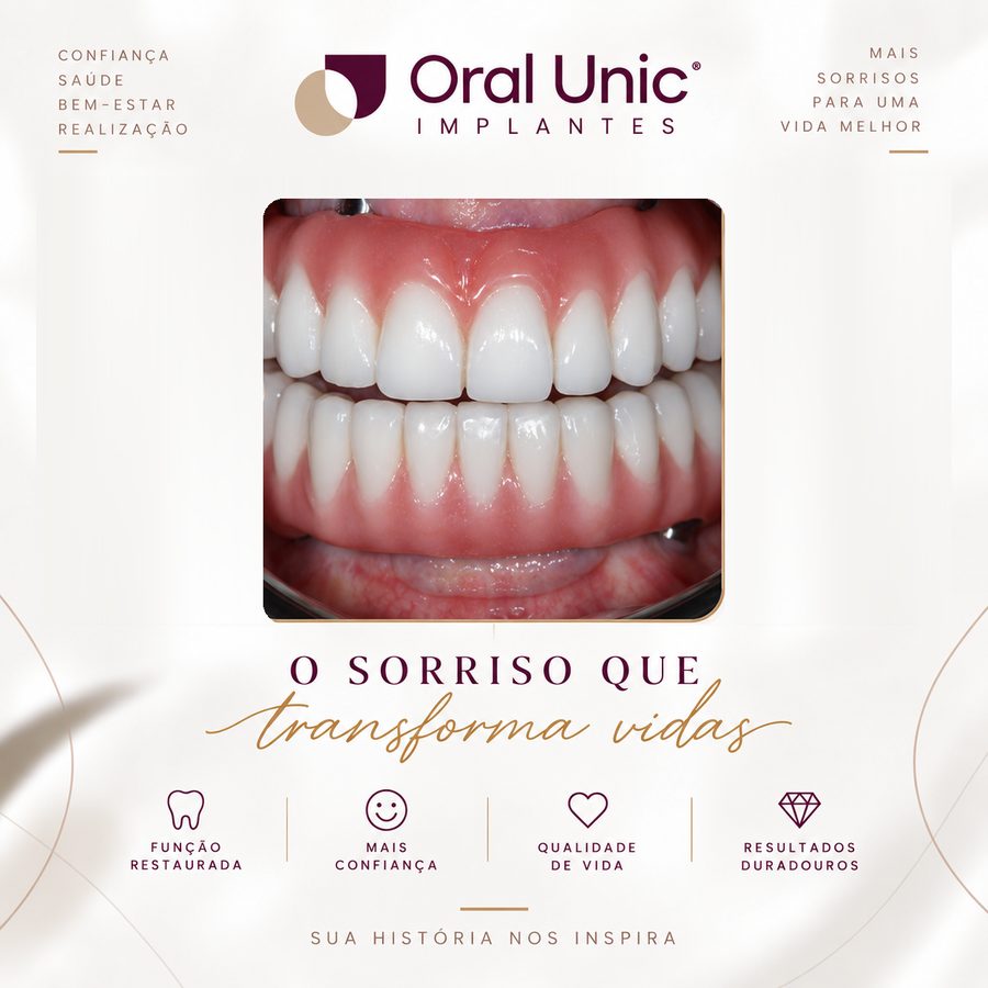 Resultado de protocolo de implante fixo realizado na Oral Unic